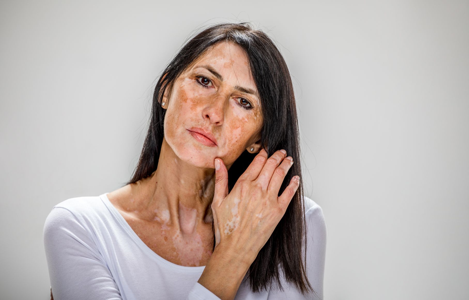 Skin Conditions (Psoriasis, Warts, Vitiligo)