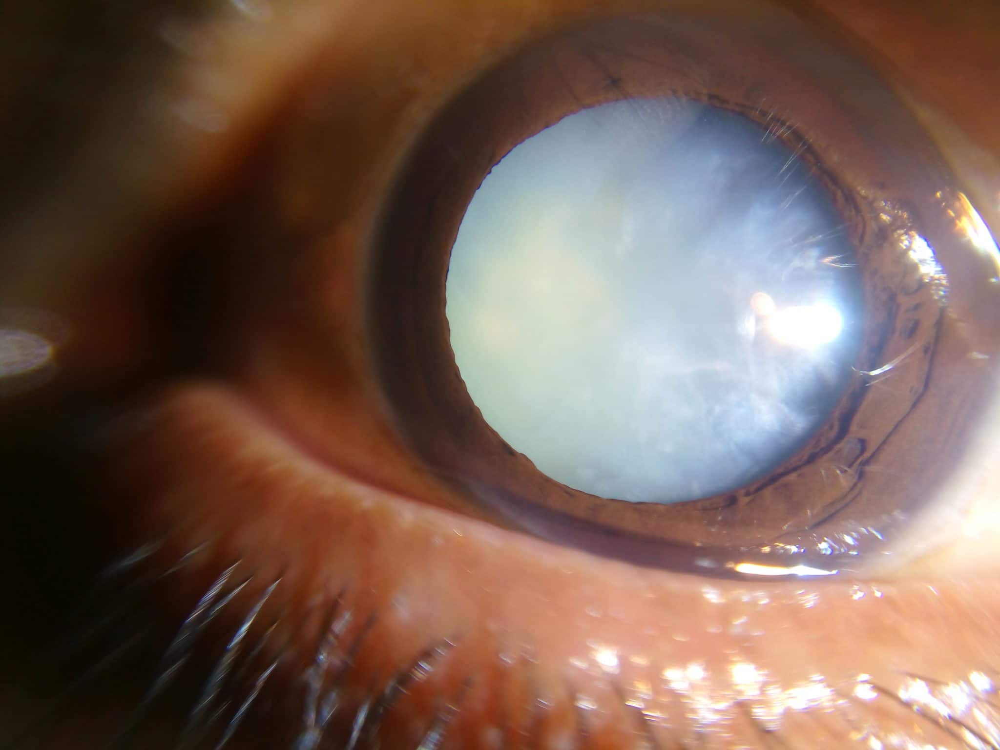 ποΈβπ¨οΈ Cataract Examination