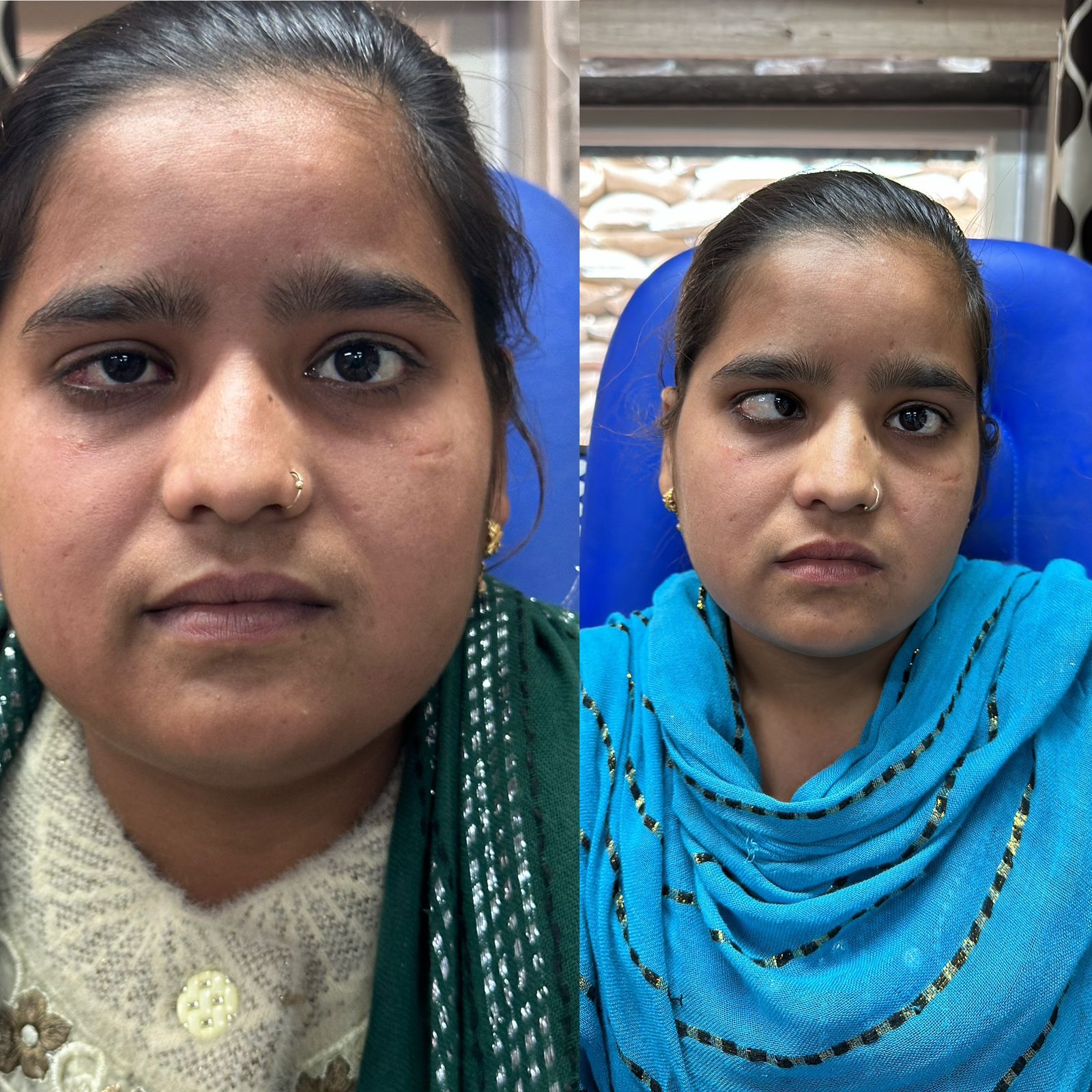 π― Squint Specialist