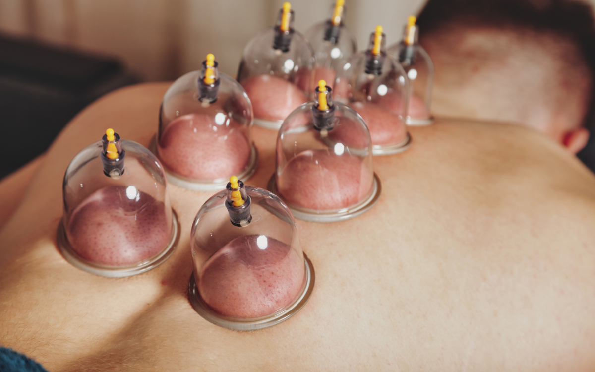Cupping Therapy (Hijama) 🔵