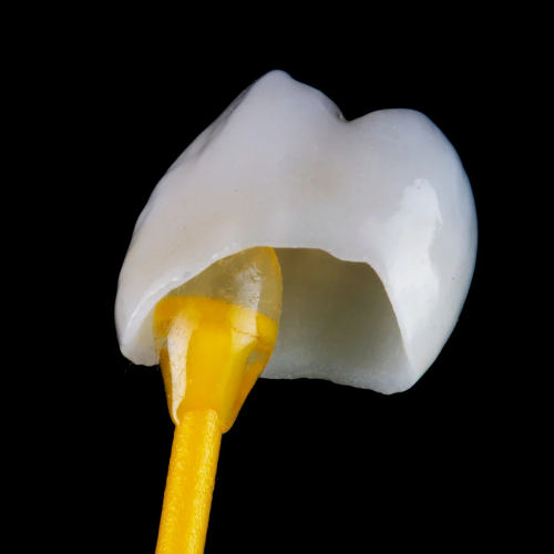 Dental Crowns & Bridges 👑