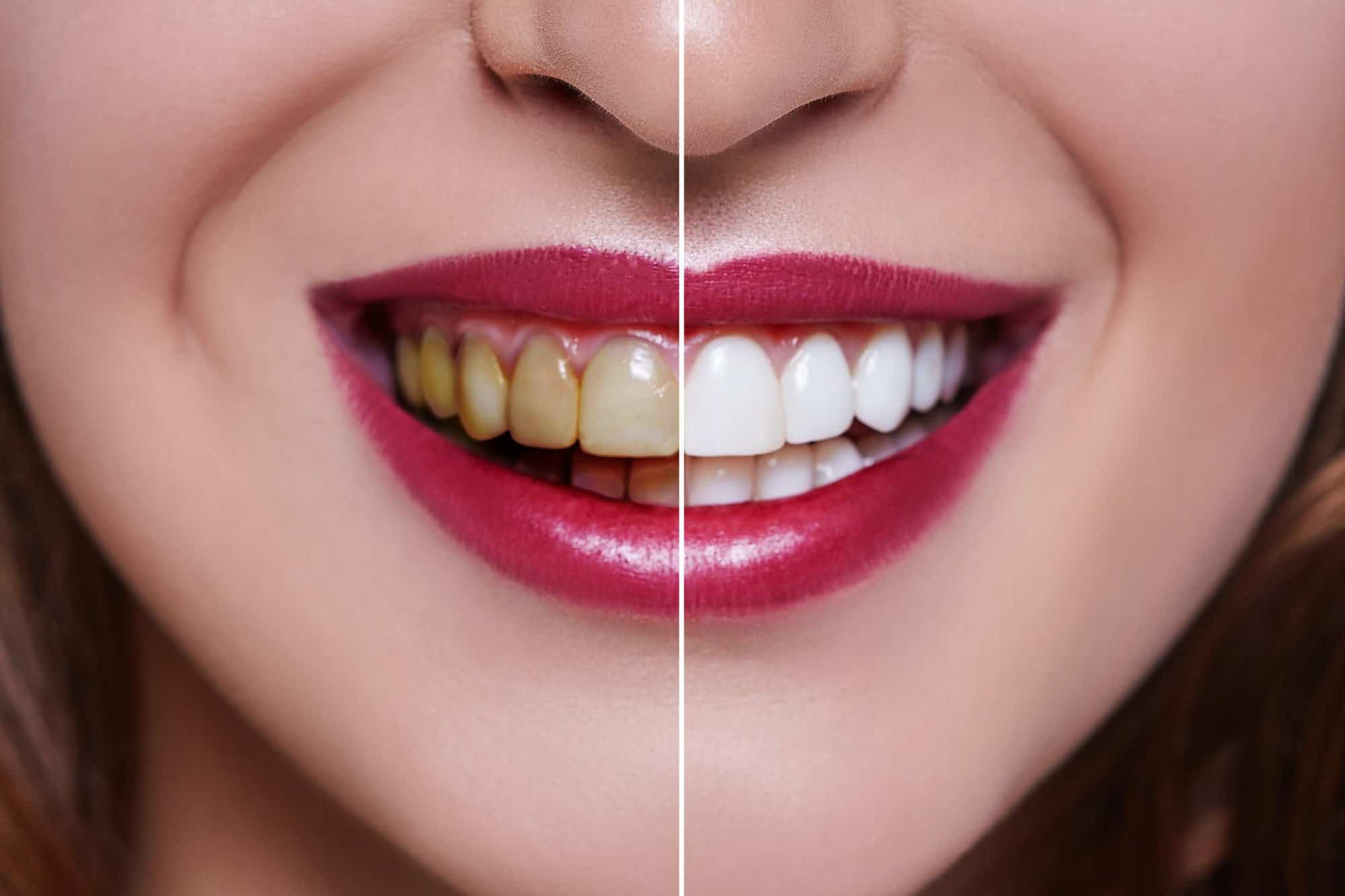 β¨ Teeth Whitening