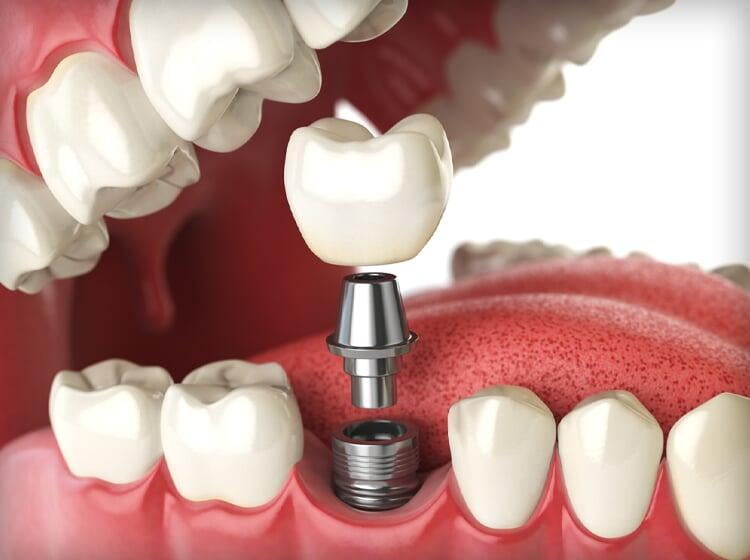 π¦· Dental Implants