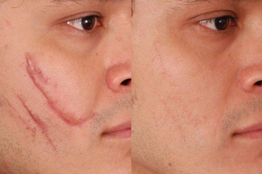 Scar & Mark Removal