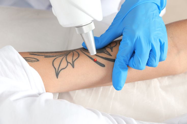 Tattoo & Unwanted Mark Removal