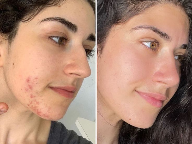 Pigmentation & Brightening