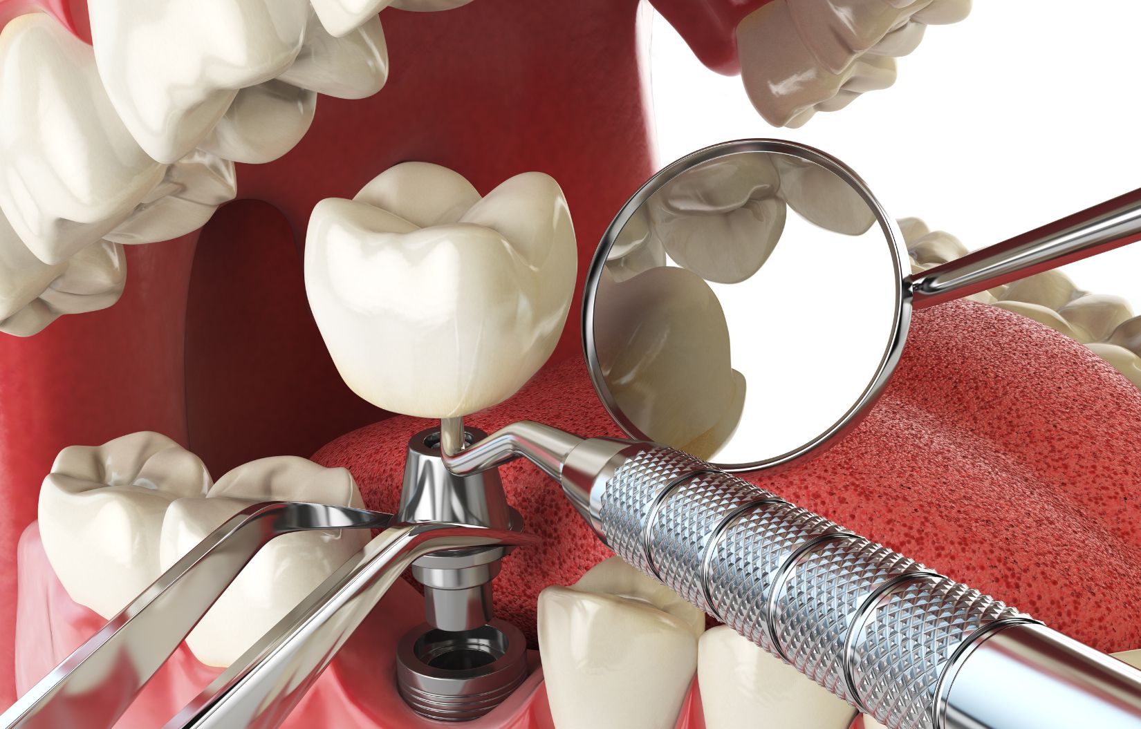 🦷 Dental Implants